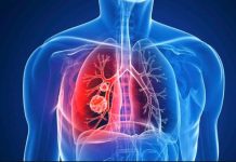 Infectados por COVID presentan secuelas seis meses después.