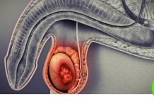Cáncer Testicular ¿Qué podemos hacer para amarnos?