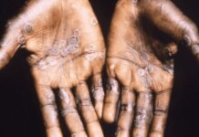 La viruela de mono y todo lo que tienes que saber