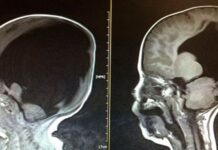 El niño que nació sin cerebro